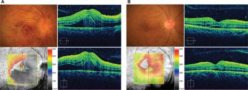 Figure 1 Comparison of fundus and spectral-domain optical coherence tomography images before and after intravenous injection of ranimizumab (IVR) as an adjunct to anti-TB therapy.