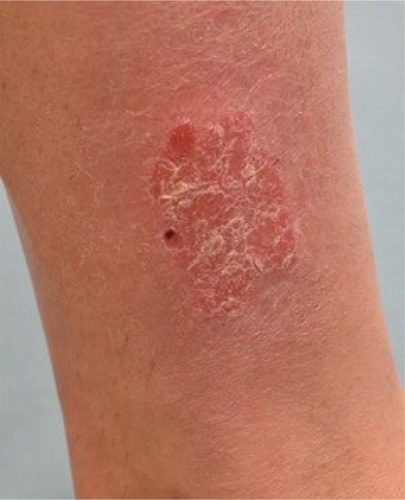 Figure 1 Plaque type psoriasis on lower extremity prior to treatment with excimer laser.
