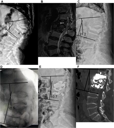 Figure 3 A 72-years old female with severe osteoporotic vertebral compression fractures (OVCFs) and kyphosis at L1-2 treated with preoperative traction (PT) followed by percutaneous kyphoplasty (PKP) combined with percutaneous cement discoplasty (PCD). (A) Lateral X-ray at admission demonstrated L1-2 severe OVCFs, and the local kyphosis angle was 46.6°; (B) magnetic resonance imaging (MRI) at admission showed severe compressed and subacute fracture of L1-2, with effusion formation in the L1 body; (C) After traction of 6 days, the lateral X-ray showed the disc height was increased and the local kyphosis angle was decreased to 21.2°; (D) After intraoperative traction using traction bed under general anesthesia, the fluoroscopic image showed the disc height was increased, the height of L1 vertebral body was restored, and the local kyphosis angle was decreased to 18.5°; (E) After operation, the lateral X-ray showed the bone cement leakage at intervertebral foramen and in front of the intervertebral space, the local kyphosis angle was 10.7°; (F) two-dimensional computed tomography scans (2D-CT) at the final follow up duration showed the local kyphosis angle was 12.0°, and the bone cement maintain at the original position.