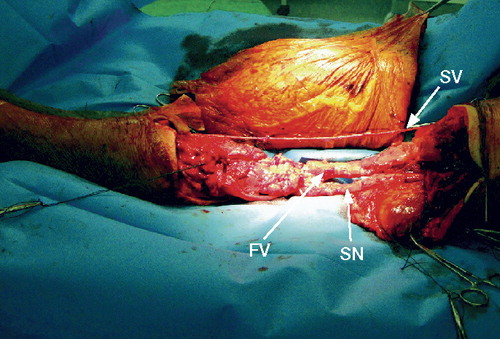 Figure 2.  Intraoperative view of the en bloc resection of the knee joint, distal tibia, and proximal femur. Osteotomies of both the femur and the tibia were performed with 2 cm margins above and below the cement spacer endomedullar stumps. The dissected saphenous vein (SV), sciatic nerve (SN), and femoral vessels (FV) are indicated with arrows.