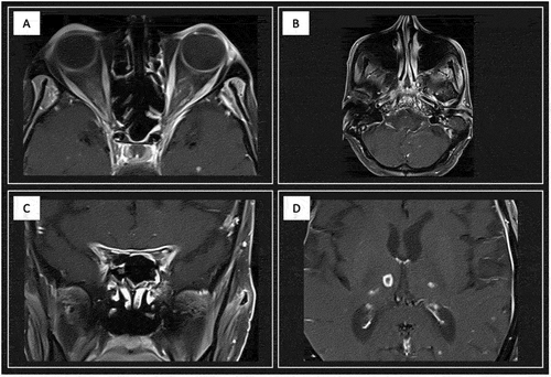 Figure 2. Magnetic resonance imaging of the brain showing (A) optic perineuritis, (B) skull base osteomyelitis, (C) tuberculum and sphenoid planum and (D) cerebral lesions.