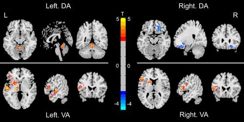 Figure 1 The differences map in rs-FC between OSA patients and HCs (two-tailed GRF correction, voxel-level P<0.01, and cluster-level P<0.05). The blue region represents decreased rs-FC, and red region represents increased rs-FC.