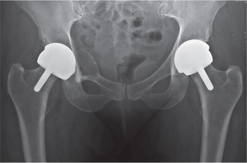 Figure 4. Preoperative radiograph of patient 34 demonstrating extensive osteolysis adjacent to the right acetabular component.
