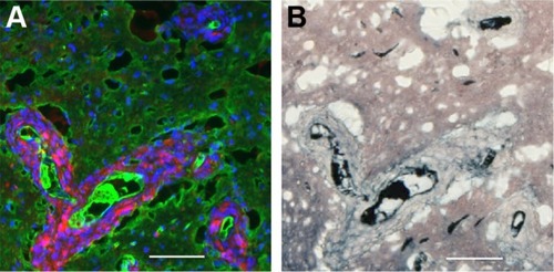 Figure 5 IV-injected AuNPs are found around tumor cells lining blood vessels and edema in peritumor region.Notes: Peritumor region: (A) fluorescence, mCherry red (tumor, red), anti-albumin (edema, green), DAPI (nuclei, blue), and anti-CD31 (blood vessels, white) and (B) gold enhanced (gold stained, black). Scale bar, 50 μm.Abbreviations: AuNPs, gold nanoparticles; CD31, cluster of differentiation 31; IV, intravenous.
