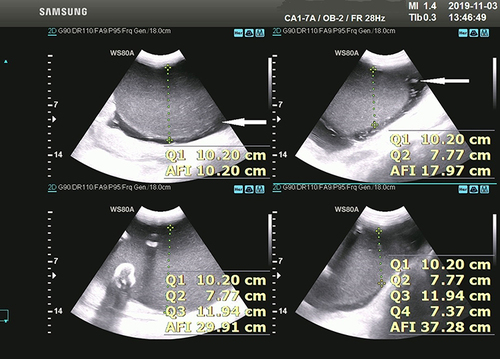 Figure 1 Ultrasonography shows mild polyhydramnios and also chorioamniotic membrane separation(CMS).