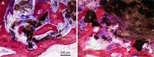 Figure 9 Representative histological section of the fiber-reinforced composites after 12 weeks on implantation.Notes: (A) Ingrowth of NB into degraded composite was visible. Composite surrounded by macrophages (yellow arrows). (B) A multinucleated giant cell (yellow dashed arrow) appears at the surface of the composite which also has been visualized in (A). Yellow arrows indicate macrophages; Yellow dashed arrow indicates a multinucleated giant cell.Abbreviations: C, composite; FT, fibrous tissue; M, macrophage; MNGC, multinucleated giant cell; NB, new bone.