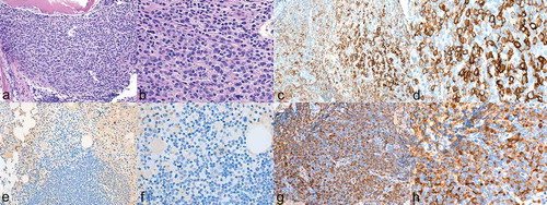 Figure 2. a–b Bone marrow with dense aggregates of plasma cells consistent with multiple myeloma. (a hematoxylin-eosin stain 100X; b 200X). c–d Immuno-histochemical staining of CD138 positive plasma cells comprising 50% of marrow cellularity. CD138 (syndecan-1) was found to be a specific marker for plasma cells. (c 100X; d 200X).e–f Stain for kappa light chain was negative (e 100X; f 200X). g–h stain for lambda light chain was positive (g 100X; h 200X).