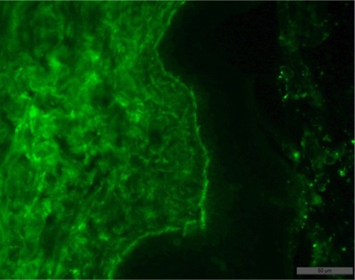 Figure 7 Result of the patient’s skin biopsy showing fixation of IgG in the basement membrane of the epidermis, on the roof the subepidermal blisters, with minor migration in the intercellular space of the epidermis and moderate in the papillary layer of the dermis.