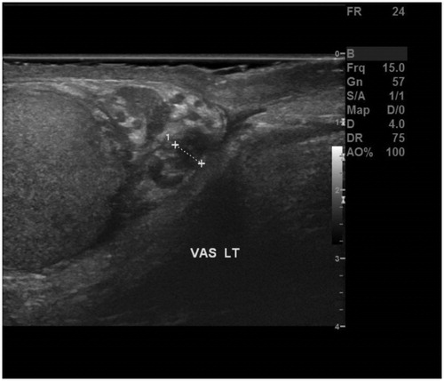 Figure 1. USS image demonstrating inflamed left vas deferens.