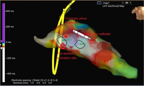 Figure 3 Electroanatomic activation map of the left ventricle for clinical ventricular tachycardia, with the earliest activation and ablation site at the posterior mitral annulus (left anterior oblique view).