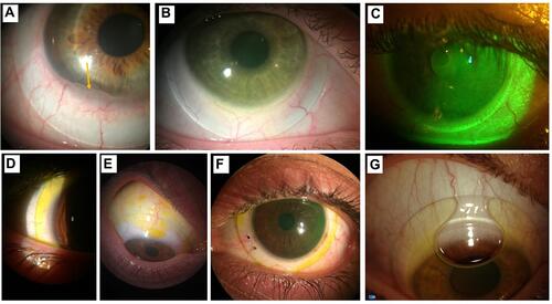 Figure 4 Slit lamp images of (A) conjunctival compression with conjunctival prolapse (arrow); (B) sectorial compression; (C) conjunctival impingement of a scleral lens; (D) lens edge lift – note the excessive fluorescein pooling under the haptic zone; (E) lens edge lift with small air bubbles; (F) lens edge lift in one Meridian while the lens is well aligned in the opposite Meridian; (G) air bubble entering into the post-lens fluid reservoir due to a poorly aligned lens. Image credits (A–F) - Daddi Fadel; (G) – Rute Araújo.