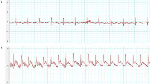 Figure 1. Electrocardiogram (ECG). (a) Before ligation; (b) After ligation. The ST-segment elevated dramatically than that of before ligation.