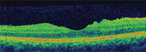 Figure 8 Close up view of horizontal optical coherence tomography scan showing normal foveal contour.