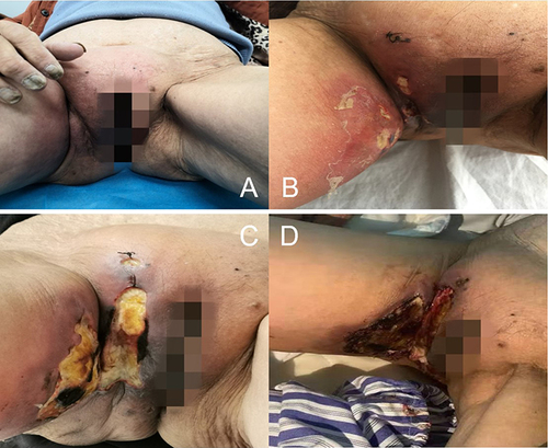 Figure 1 Clinical Presentation of the Patient in the right vulva, groin, and thigh ((A): Erythema and swelling in mid-January 2021; (B) Erythema, swelling, and multiple superficial ulcers on February 18, 2021; (C) Enlargement of skin ulcers with local necrosis on March 11, 2021; (D) Further progression of skin ulcers on March 17, 2021).