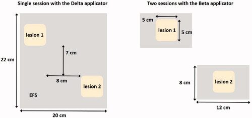 Figure 7. Two possible treatment strategies for heating two melanoma lesions; a single session using the ALBA-4000 ON Delta applicator, or two sessions using the Beta applicator.