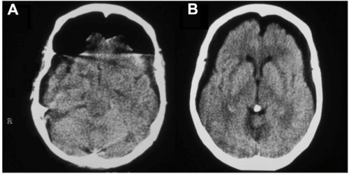 Figure 2 (A) Axial CT view depicting a subdural posttraumatic PNC. (B) Radiological evaluation after four sessions of HBO2 therapy demonstrates significant absorption of the intracranial air bubble.
