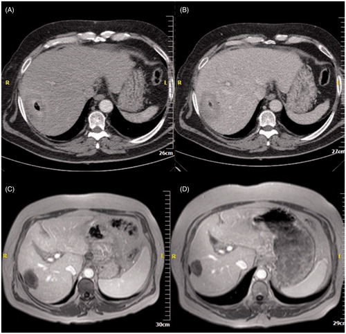 Figure 3. (A,B) Computed tomography axial scan post-IV contrast medium injection in arterial (A) and portal venous (B) phase immediately postablation – the ablation zone extends subcapsularly with gas at the centre. (C,D) MRI post-IV contrast medium injection in arterial phase, one (C) and two (D) years postablation illustrates capsular retraction, no contrast medium uptake and no viable tumour.