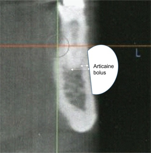 Figure 2 Measurements were taken on the CBCT from the tooth apex to the facial aspect of the mandible and the thickness of the cortex at that location.