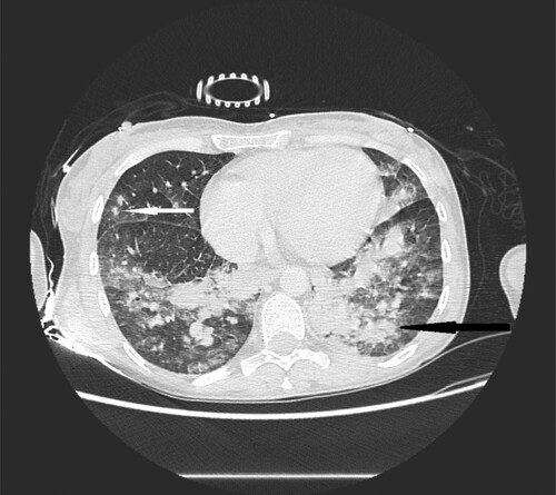 Figure 3. 40-year-old female with cutaneous T-cell lymphoma presenting with fever and dyspnea. High resolution CT scans obtained at level of lower lobes shows consolidations (black narrow arrow) and multiple nodules with halo sign located in both lungs (white narrow arrow).