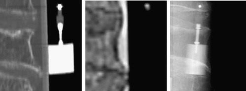 Figure 3. Close-up views of fiducial markers in CT (left), MR (center) and X-ray (right) images.