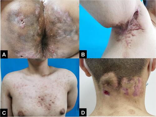 Figure 1 Clinical manifestation of FOT. (A) Multiple purulent sinus tracts in the buttocks. (B) Hyperplasia scar in the left axillary which caused limitation of abduction. (C) Multiple anterior thoracic follicle infections with keloid. (D) inflammatory nodules and papules in the occipital.