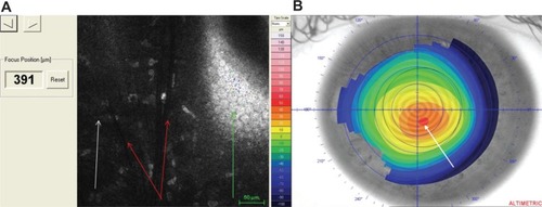 Figure 1 Confocal pachymetric scan and topographic keratoconus apex localization.