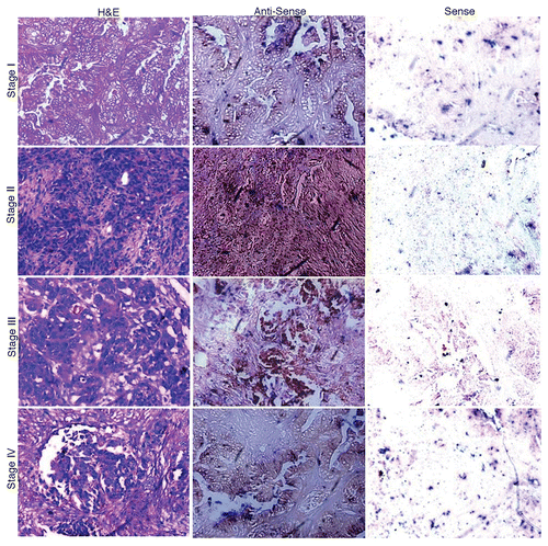 Figure 2. In situ localization of AKAP4 mRNA in representative Stage I, Stage II, Stage III and Stage IV ovarian cancer tissue specimens. Ovarian cancer samples representative of all FIGO stages were stained with hematoxylin and eosin (left panels) or with AKAP4-specific anti-sense (middle panels) or sense (right panels) riboprobes, the latter as a negative control condition. Original magnification = 200×, = objective 20×.