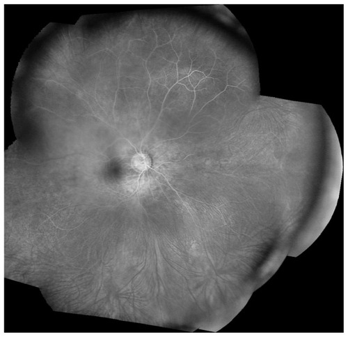 Figure 5 Montage fundus photograph showing peripheral avascularity.