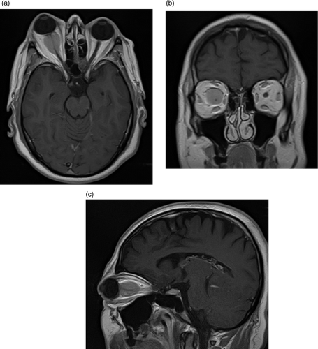 Figure 1. Case II. Axial (a), coronal (b) and sagittal (c) gadolinium-enhanced T1 MR sequences show an atrophic but clearly visible right optic nerve encased by a globular contrast-enhancing homogeneous lesion. The axial cut shows well the perineural growth pattern typical of ONMS, while the entire intraorbital course of the nerve can be appreciated. The same lesion appears on CT imaging [illustrated here in the context of the treatment plan (d)] as a large contrast-enhancing lesion encasing the right optic nerve.