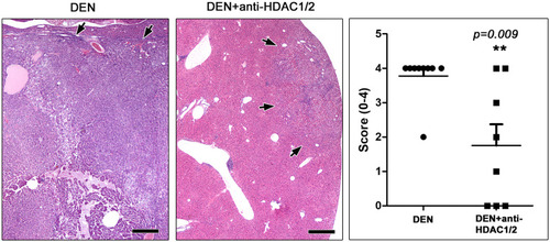 Figure 1 Anti-HDAC1/2 treatment counteracts HCC at 10 months after DEN administration. Large, expansive HCC in a DEN-treated mouse that received no further treatment. A small well-circumscribed hepatic cell tumor from a mouse that was further treated with Romidepsin is shown on the side for comparison. Arrows depict tumor tissue margins. Histopathological scores reflecting the extent of neoplastic invasion of liver tissue suggest that Romidepsin treatment suppressed liver tumors at statistically significant levels. Hematoxylin and Eosin. Scale bars: 500 μm. Numbers on the y-axis of bar graph correspond to the mean±SEM of histological score; ** p<0.001.Abbreviations: DEN, diethylnitrosamine; HDAC, histone deacetylase.