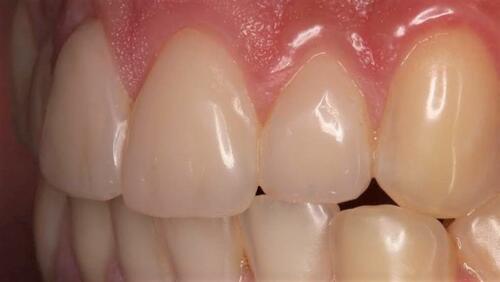 Figure 10 Final restorations.