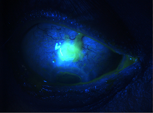 Figure 5 Bleb leak with positive Seidel test viewed after fluorescein staining.
