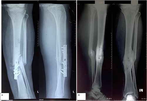 Figure 4 Figure 4 Sample case of malunion from study with open fracture tibia-fibula directly performed ORIF in acute onset disaster, (A) 2 months post-operative X-ray. (B) oneyear post-operative X-ray.