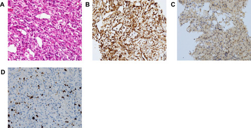 Figure 6 Pathological results of the puncture of the space-occupying liver lesions. Haematoxylin–eosin (H&E) staining of biopsy samples (40×) magnification. (A) Immunohistochemical staining results of the puncture of the space-occupying liver lesions: vimentin + (B), HMB45 + (C), ki-67 15% (D).