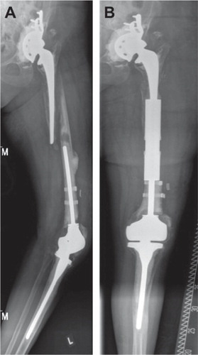 Figure 2. A. Interprosthetic femoral fracture in a 78-year-old woman. B. Follow-up radiograph after 1.5 years. At this stage the patient was mobile with a walker and free of pain (HSS 55).