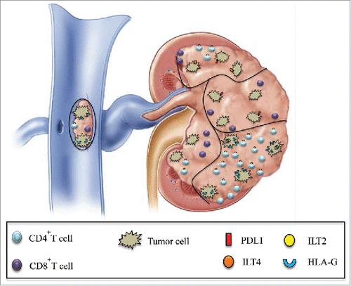 Figure 7. Schematic representation of the simultaneous expression of various immune checkpoints in different tumor areas is shown. Intratumor heterogeneity of PD1/PDL1 and HLA-G/ILT expression in various areas of the same tumor, including the tumoral thrombus of the renal vein, can be observed both at tumor cell and infiltrating CD4+ and CD8+ T cell levels.