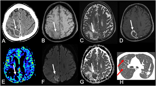 Figure 4 50-year-old man presented with headache. Brain CT revealed an hypodense expansive lesion in the right parietal lobe, with peripheral contrast-enhancement (arrow in (A)). Brain MRI demonstrated that the lesion had mild hyperintense signal on T1- (arrow in (B)) and hypointense signal on T2-weighted imaging (arrow in (C)), with peripheral gadolinium-enhancement (arrow in (D)). The lesion also had reduced rCBV, on the semiquantitative CBV color map (arrow in (E)). Furthermore, the lesion had restricted diffusion, with hyperintense signal on DWI (arrow in (F)) and hypointense signal on apparent diffusion coefficient map (arrow in (G)). Chest CT in the pulmonary window demonstrated clusters of small nodules (red arrows in (H)) and a mass (white arrow in (H)).
