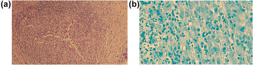 Figure 3 (a) Non-caseating granulomatous infiltrate (hematoxylin and eosin staining). (b) Variety of inflammatory cells infiltrate (polymorph nucleated neutrophils, epithelioid histiocytes) with partial giant cell formation, no extracellular Mycobacterium tuberculosis was detected (Ziehl-Neelsen stain).