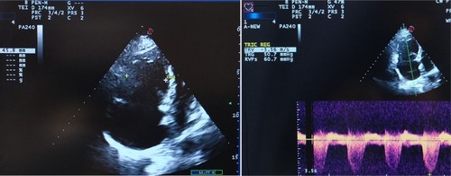 Figure 2 Transthoracic echocardiogram showing (left) right heart dilatation and (right) pulmonary hypertension.