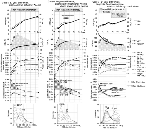 Figure 4. Notes: Identification of time-series trends of iron deficiency states related to clinical events and treatments using the SF-3000 analyzer.Clinical problem: Case 5 showed typical recovery from iron-deficiency anemia. However, in both Cases 6 and 7, retardation in the recovery of HGB and/or HCT was apparent by three weeks after the start of medication: the cause in Case 6 appeared to be severe menstrual bleeding; the cause in Case 7 appeared to be iron deficiency complications related to treatment for pernicious anemia. Main relevant results from the superimposed RBC size distributions: [“-fr”=“fraction”]. Cases 5 and 6: Both cases exhibited a similarly decreasing microcytic fraction and increasing Nor-fr. However, only Case 6 exhibited an emerging peak in Mac-fr with a bimodal pattern in the RBC size distribution. Case 7: Concurrent with a decreasing megalocytic state (in which Meg-fr was dominant), an upward trend in not only Nor-fr but also Mic-fr was observed. Inferred Clinical Significance of Time-Series Differential Indices: The durations of the microcytic states of [θMic−θNor] > 0π in both Case 5 and Case 6 were similar at slightly more than three weeks after the start of medication, but the transient macrocytic state of [θMac−θNor] > −0.05π in Case 6, which suggests a response of excessive erythropoiesis to massive bleeding, might have caused the very early recovery in MCV value. In Case 7, the microcytic state might reflect the extent of iron deficiency, and the prior progressing trend toward a microcytic state might help guide the timing/need for ferric treatment to occur at least one week earlier than conducted for Case 7.