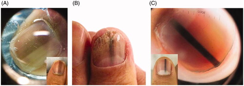 Figure 6. Clinical and dermoscopic findings of benign LM. (A) Ethnic melanonychia. On dermoscopy, grey background with multiple thin grey lines. (B) Melanocytic activation secondary to onychomycosis of the right thumbnail. (C) Junctional naevus. (DOI: 10.1016/j.jaad.2018.08.033, Permission for reuse of these images has been obtained from the copyright holder (Elsevier) and applies to publications with the Creative Commons license).