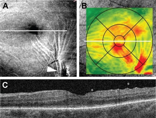 Figure 2 Retinal wrinkling associated with eccentric epiretinal membrane. (A) En face image demonstrates epiretinal membrane (arrowhead) and tension lines spreading along the inner retinal surface to the foveal center. (B) Retinal thickness map shows retinal thickening within central subfield. (C) B-scan through the foveal center demonstrates retinal wrinkling (asterisks). The white line represents the position of B-scan.