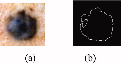 Figure 7. Fractal dimension calculation using the method box counting, (a) original image, (b) edge of the tumor.