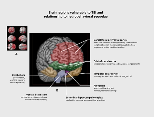 Figure 3. (A) Brain regions vulnerable to damage in a typical traumatic brain injury (TBI); (B) Relationship of vulnerable brain regions to common neurobehavioral sequelae associated with TBI.(A) Adapted from ref 112: Bigler E. Structural imaging In: Silver J, McAllister T, Yudofsky S, eds. Textbook of Traumatic Brain Injury. Washington DC: American Psychiatric Press; 2005:87. Copyright © American Psychiatric Press, 2005. (B) Adapted from ref 111: Arciniegas DB, Beresford TP. Neuropsychiatry: an Introductory Approach. Cambridge, UK: Cambridge University Press; 2001:58. Copyright © Cambridge University Press, 2001