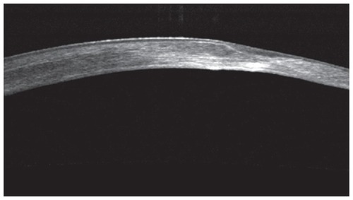Figure 2 Preoperative cornea OCT showing the dense, deep stromal scarring (hyper-reflective spots) along with the very irregular stromal surface, partly masked by epithelium thinning over the peaks and thickening over the deep valleys.