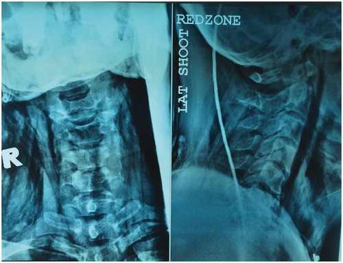 Figure 1. Anteroposterior and lateral view of neck radiograph showing extensive subcutaneous emphysema.