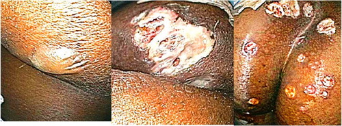 Fig. 1 Skin lesion starting as flaccid bulla resulting in deep purulent ulcer.