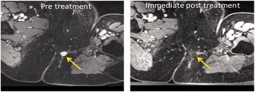 Figure 4. Axial T1W image with fat suppression pulse and after contrast enhancement with gadolinium chelate before and after treatment of an extra-pelvic tumor. The pretreatment image shows the enhancing nodule of recurrent tumor in the left ischio-rectal fat (yellow arrow). Immediately post-treatment there is complete ablation of this enhancing lesion (yellow arrow).