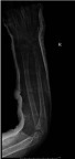 Figure 2 X-ray after closed reduction showing excellent alignment.