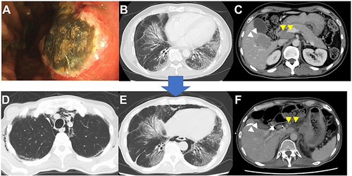 Figure 3 Upper gastrointestinal endoscopy and CT in case 2. (A) Upper gastrointestinal endoscopy before chemotherapy. (B and C) CT revealed interstitial pneumonia and lymph node and lung metastases before chemotherapy. (D–F) CT showed mediastinal and subcutaneous emphysema after two courses of pembrolizumab, while interstitial pneumonia was almost stable and the metastatic lesions had maintained shrinkage. Explanations: Yellow arrows in (C and F) show lymph node metastasis; White arrows in (C and F) shows liver metastasis.